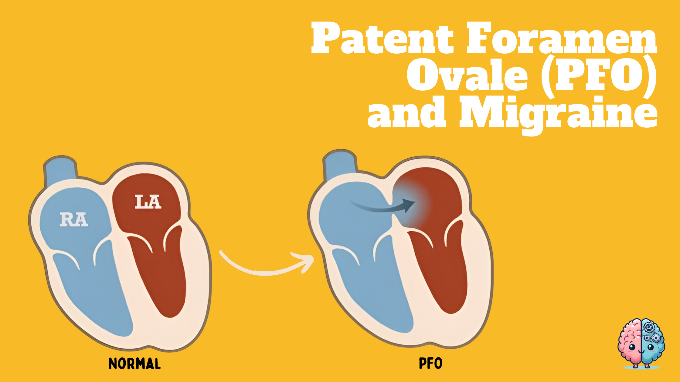 Patent Foramen Ovale and Migraine – Cerebral Torque