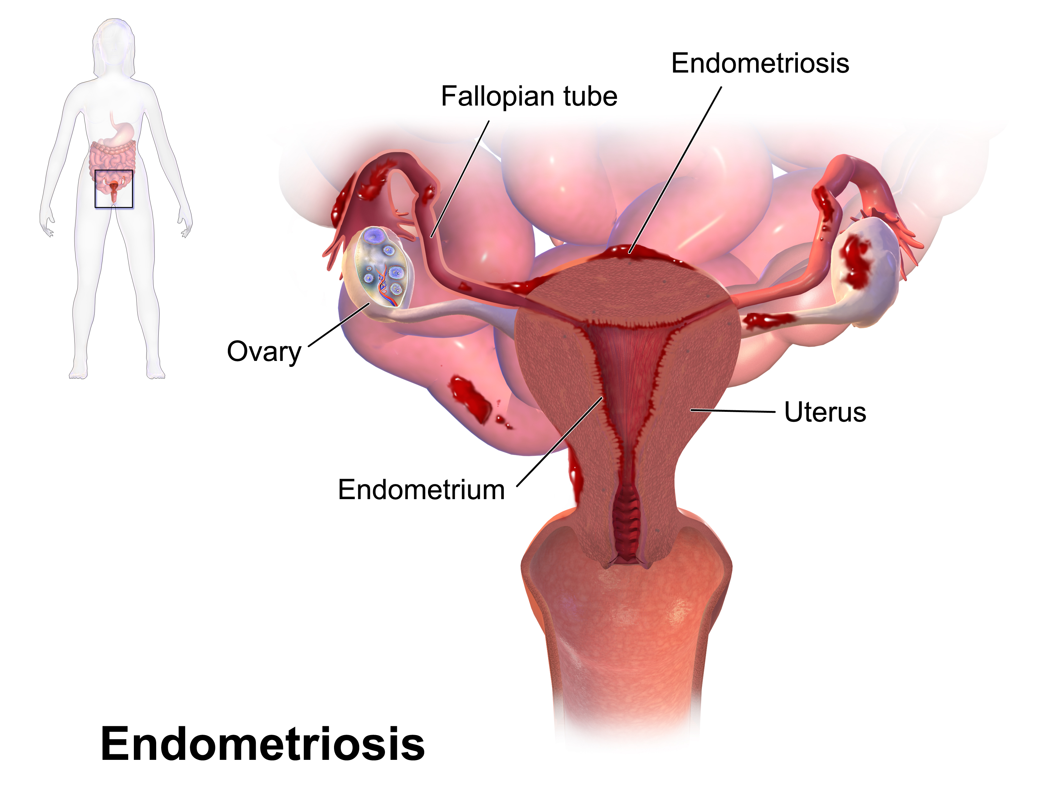 Understanding the Link Between Endometriosis and Migraine